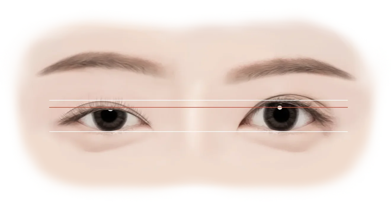 Eyes with lines for 345 plastic surgery where natural, cosmetic procedure.