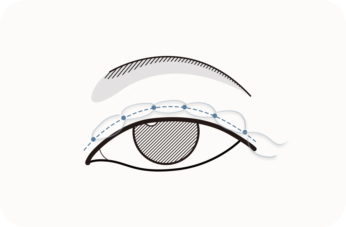 Eyelid crease line for 345 plastic surgery where natural cosmetic procedure.