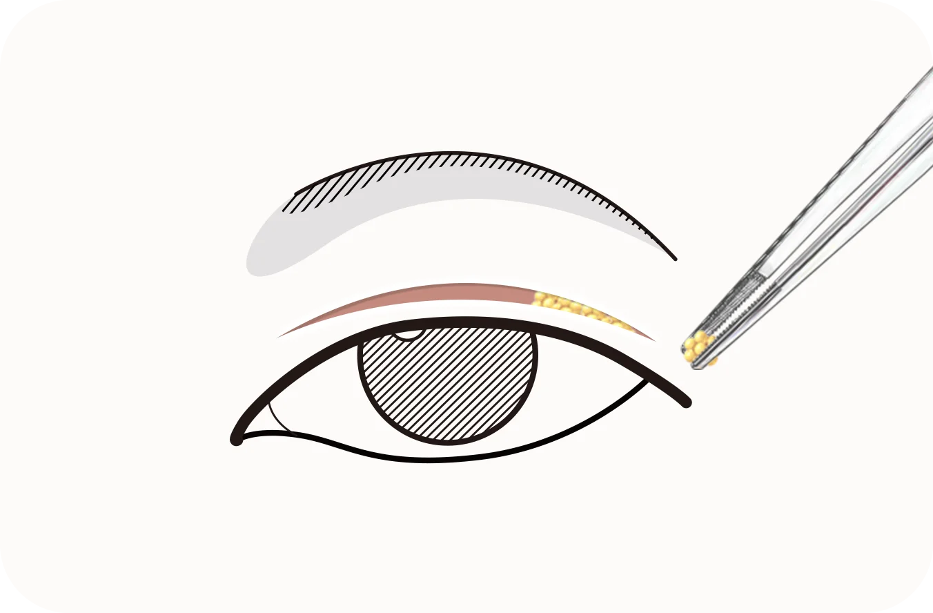 345 Plastic Surgery where natural eye illustration for eyelid plastic surgery.
