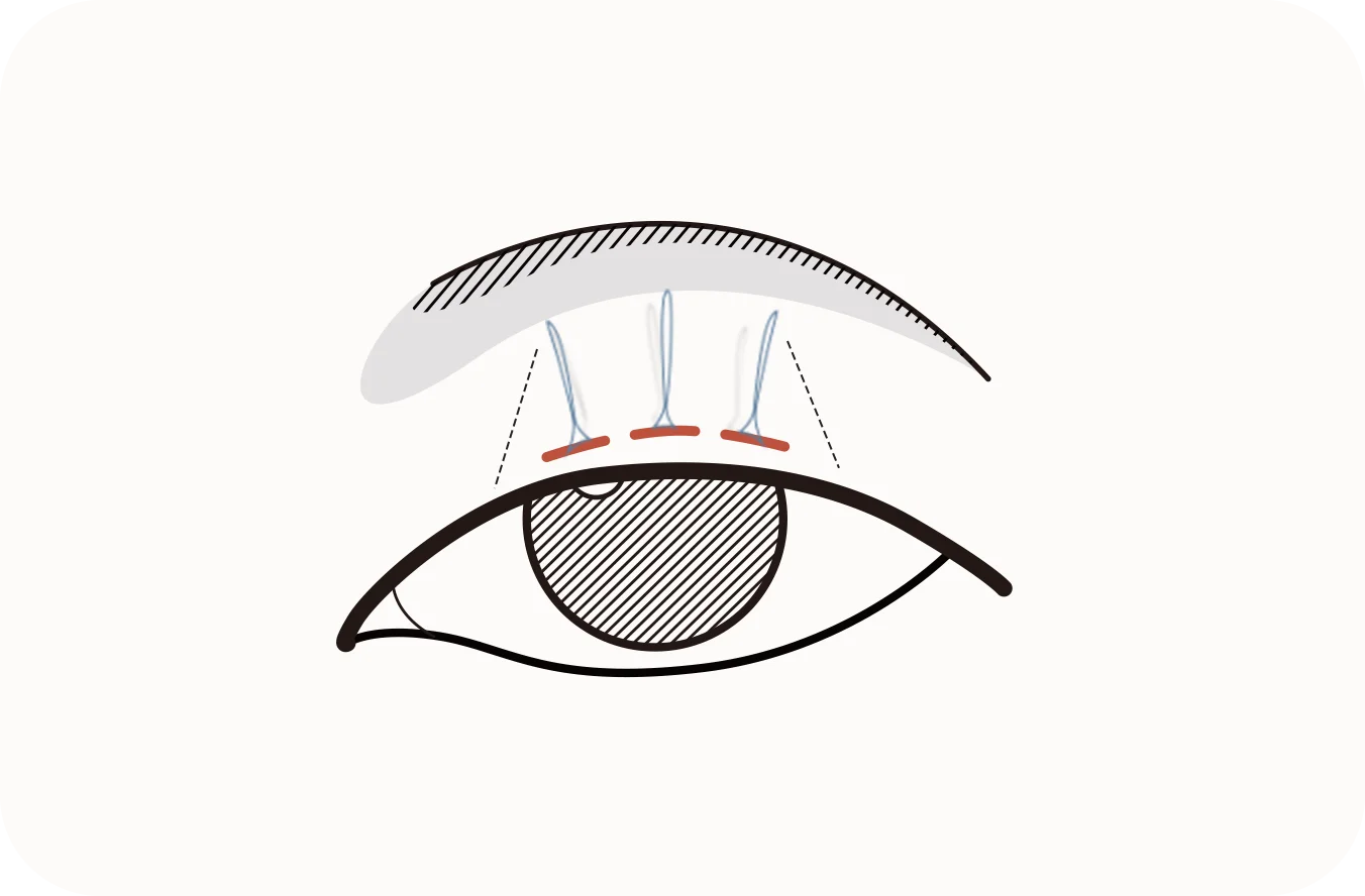 Eye lift diagram for 345 plastic surgery where natural results are achieved.
