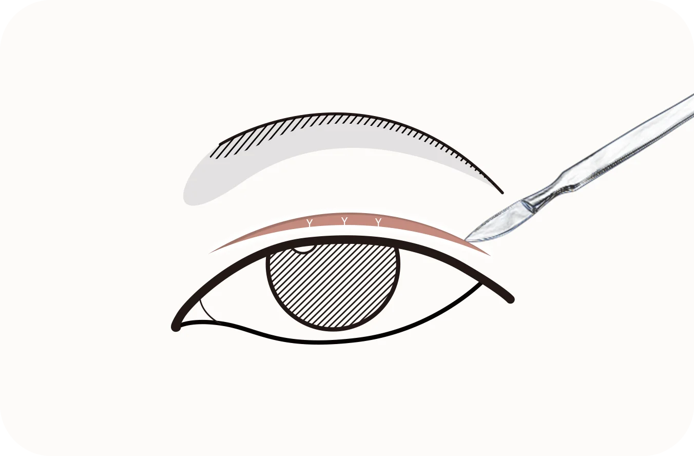 Double eyelid plastic surgery illustration for natural looking 345 results