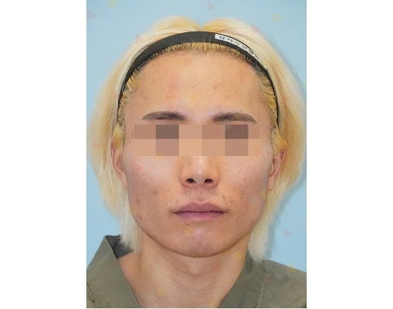 Asian male face before 345 plastic surgery where natural skin imperfections visible