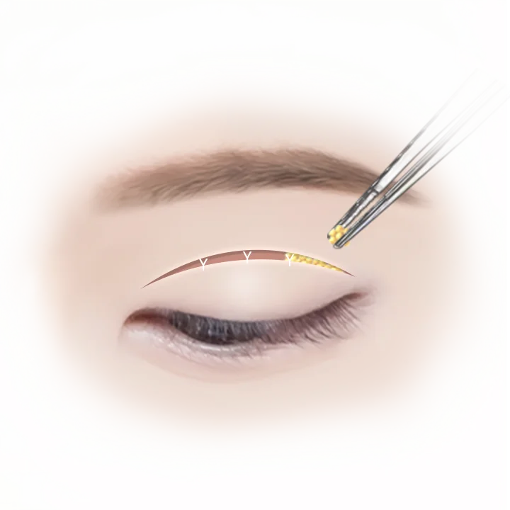 Eyelid plastic surgery illustration. Tweezers holding fat. 345 Plastic Surgery where natural.