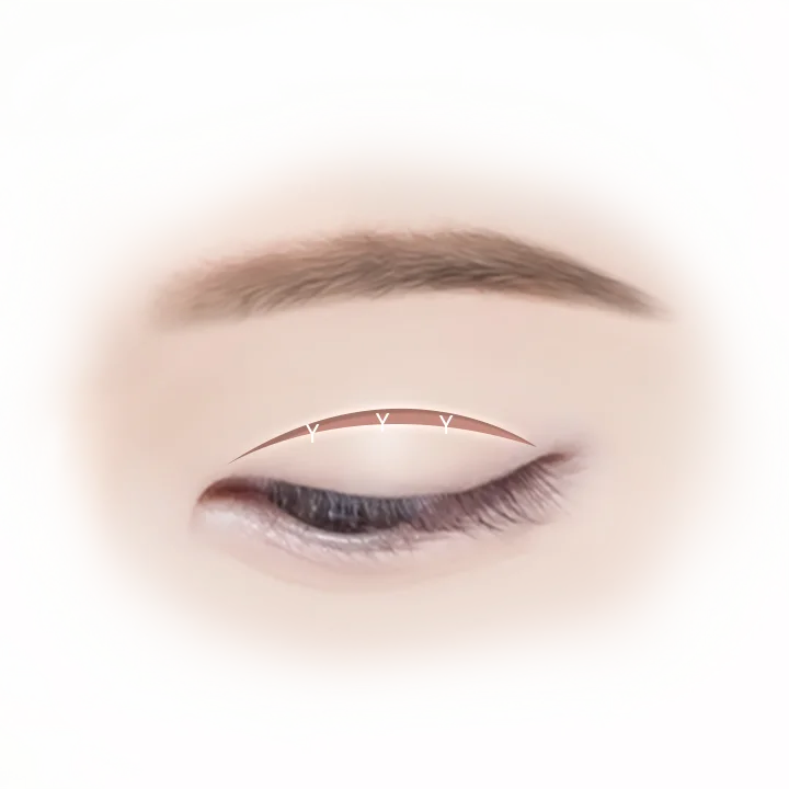 Eyelid crease marked for 345 plastic surgery where natural