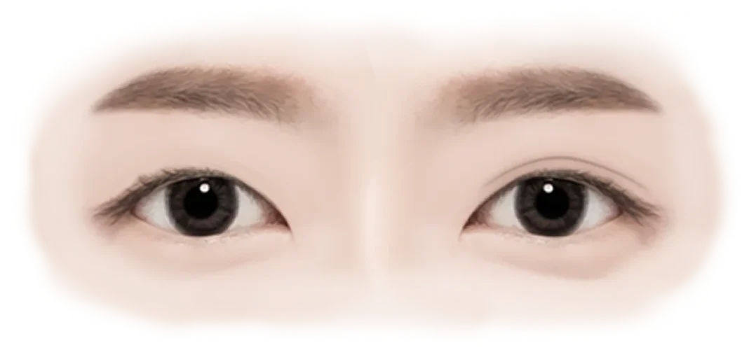 Asian eyes before and after 345 plastic surgery where natural. Double eyelid surgery.