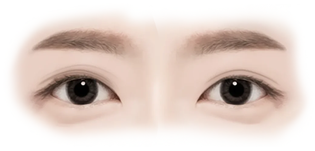 Asian eyes before and after 345 plastic surgery for natural results.