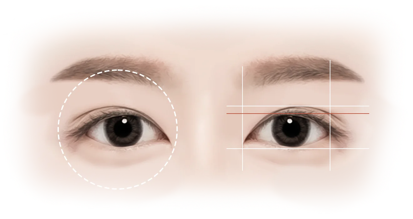 Asian eyes before after 345 Plastic Surgery where natural. Double eyelid surgery diagram.