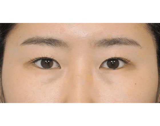 Asian woman's eyes before 345 plastic surgery for natural look. Cosmetic procedure.