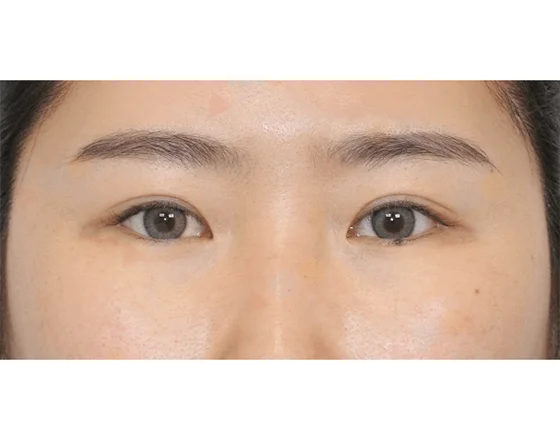 Asian woman's eyes before 345 plastic surgery where natural.