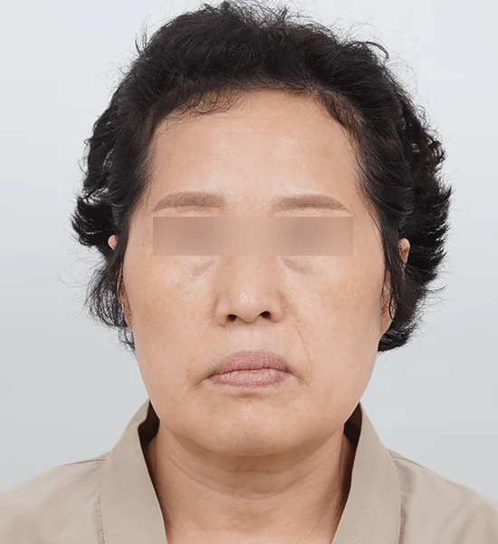 Mature woman before 345 plastic surgery where natural face rejuvenation