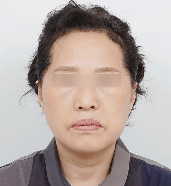 Asian woman face before 345 plastic surgery where natural, eyes blurred