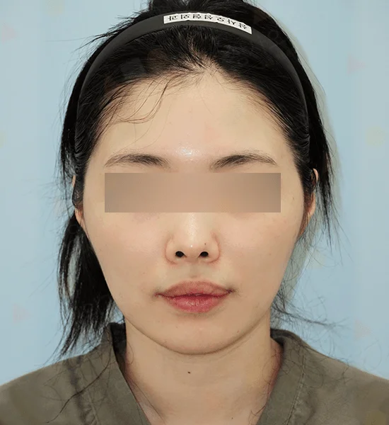 Asian woman before 345 plastic surgery procedure where natural results are desired