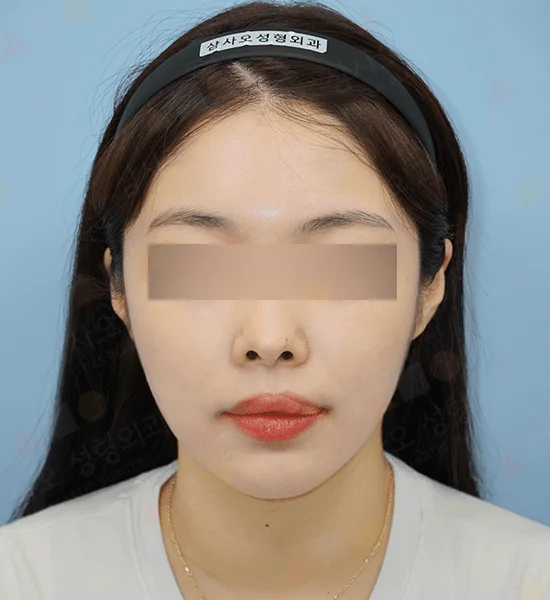 Asian woman face before 345 plastic surgery where natural face is shown.
