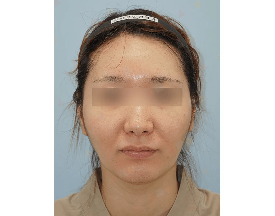 Woman's face before 345 Plastic Surgery procedure where natural results are desired.