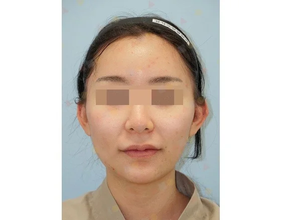 Asian woman before 345 plastic surgery where natural face view