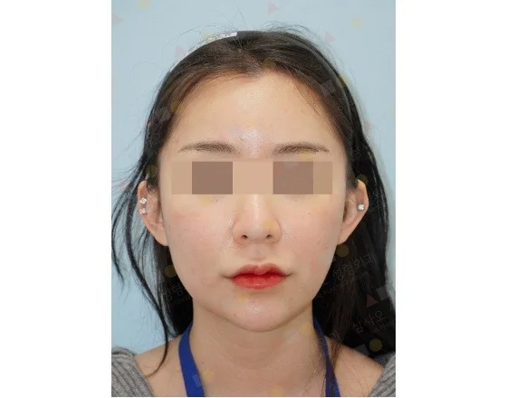 Asian woman before 345 plastic surgery where natural face covered.