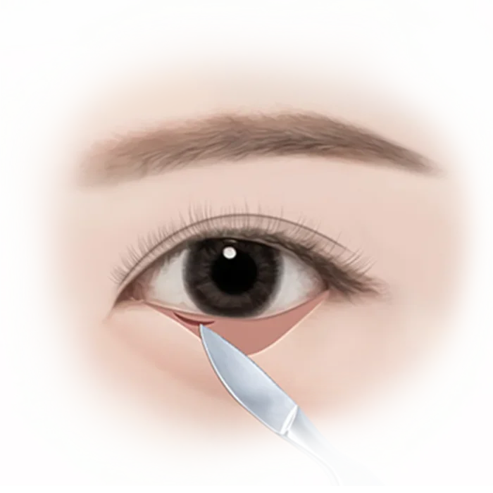 Eyelid surgery illustration with scalpel