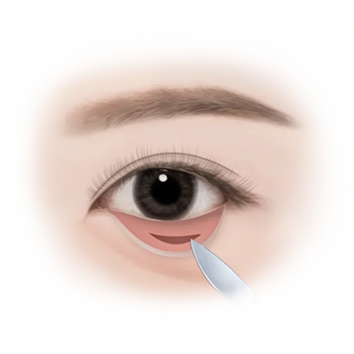 Illustration of lower eyelid surgery procedure.