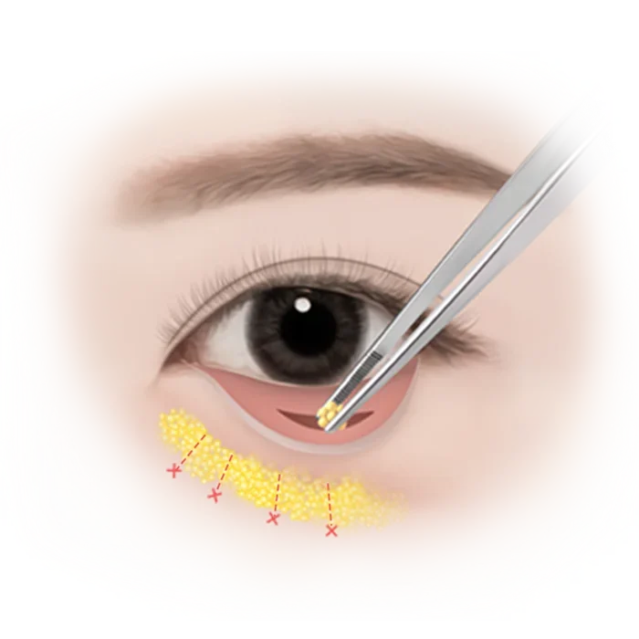 Eyelid surgery illustration with surgical tools.