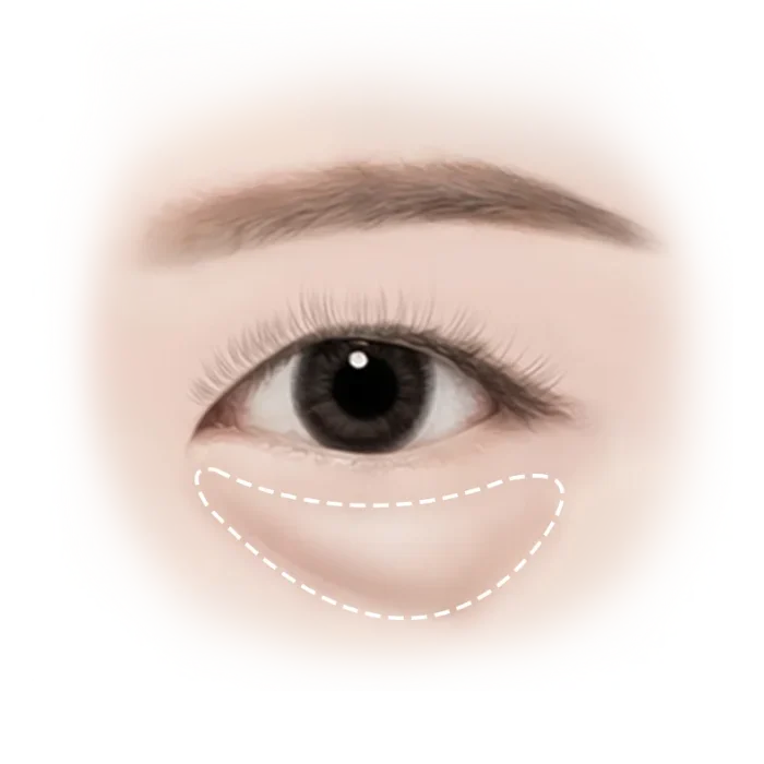 Illustration of eye showing under-eye area