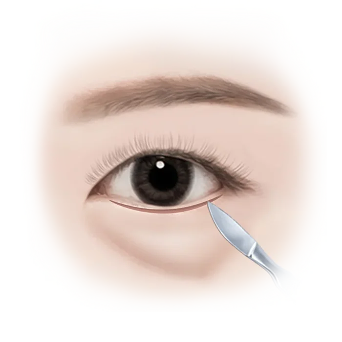 Illustration of lower eyelid surgery procedure.