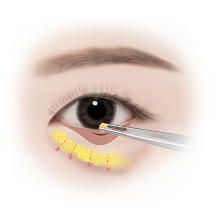 Eyelash application with tweezers and yellow adhesive.