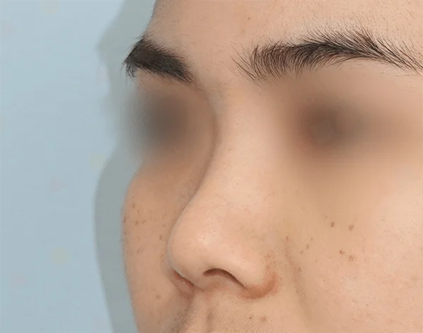 Man with freckles before 345 plastic surgery for natural look.