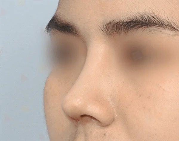 Profile of face for 345 plastic surgery where natural nose reshaping is performed.