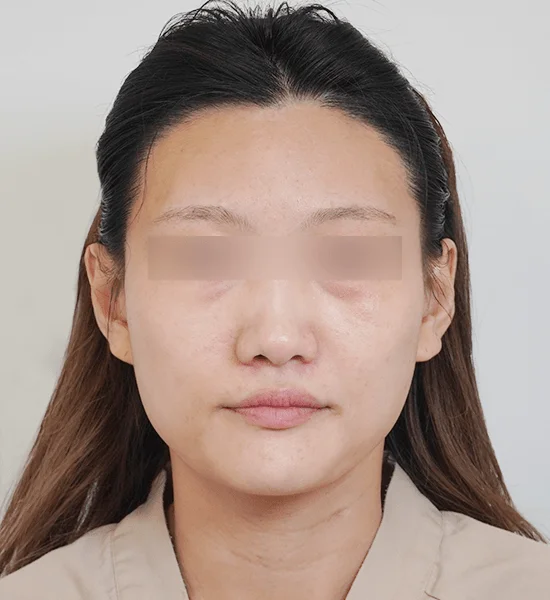 Asian woman before 345 plastic surgery where natural face view
