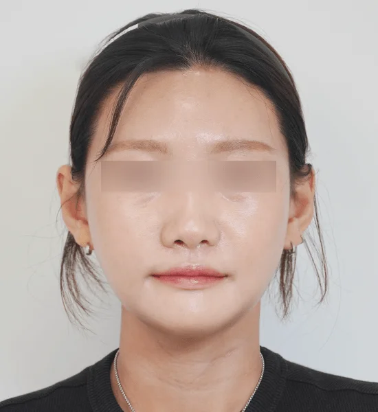 Asian woman with 345 Plastic Surgery for natural results. Face before cosmetic procedure.