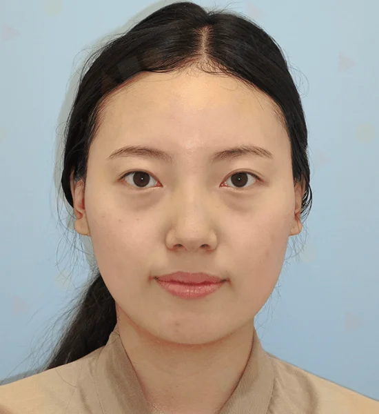 Asian woman before 345 plastic surgery procedure for natural results