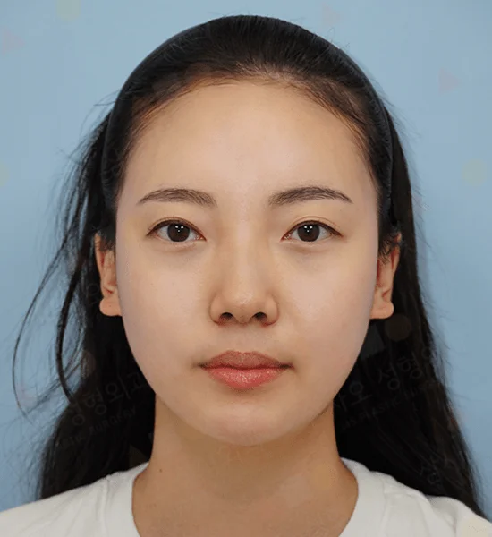 Asian woman face before 345 plastic surgery where natural results.