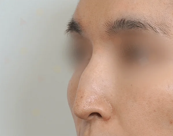 Close-up of a face before 345 plastic surgery where natural, showing the nose and upper face.