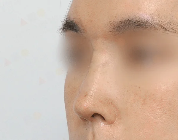 Close-up of a nose before 345 plastic surgery for natural results.