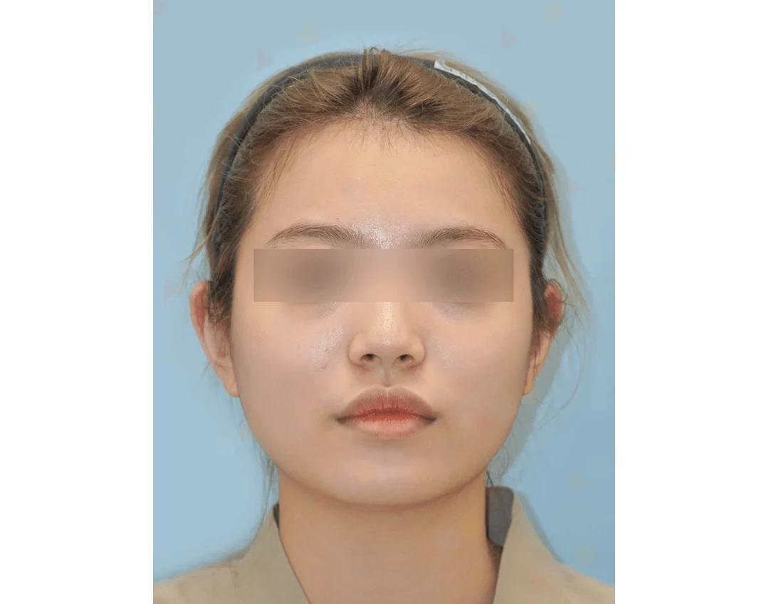 Asian woman face before 345 plastic surgery where natural look is desired.