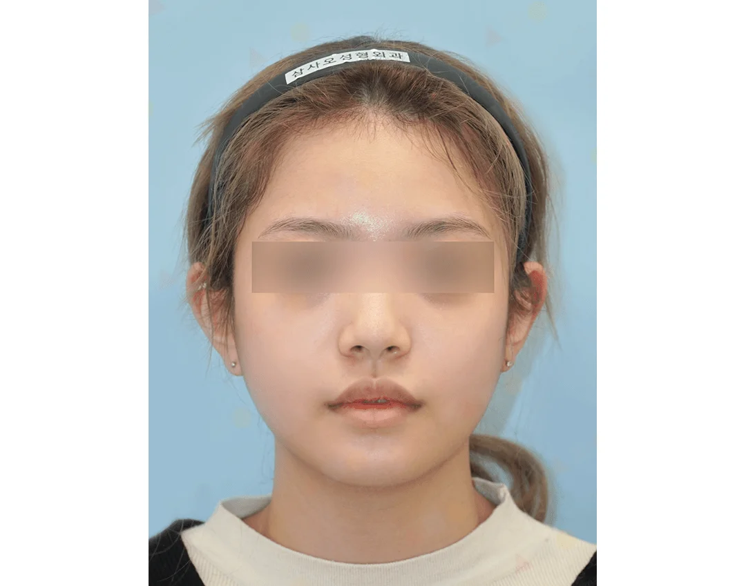 Asian woman before 345 plastic surgery for natural results.