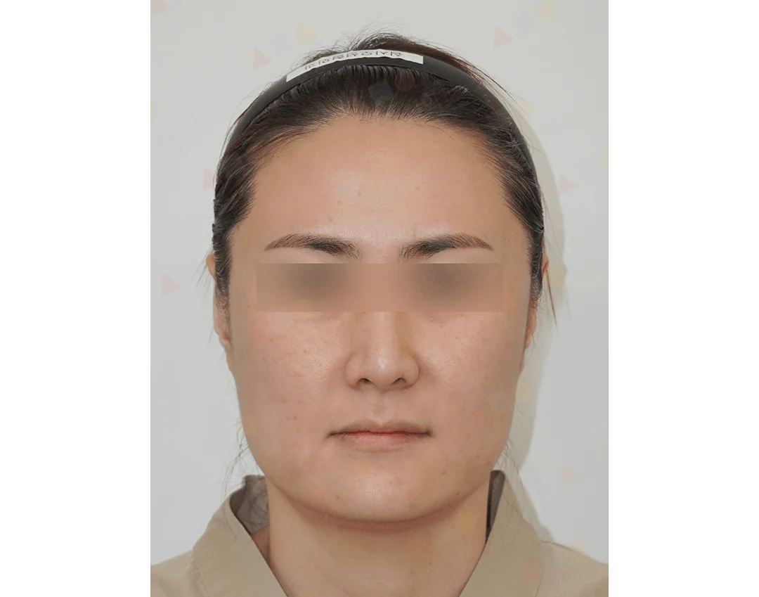 Asian woman before 345 plastic surgery where natural face view.