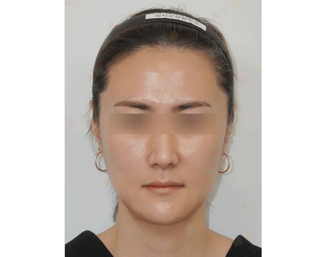 Asian woman face before 345 plastic surgery for natural look.