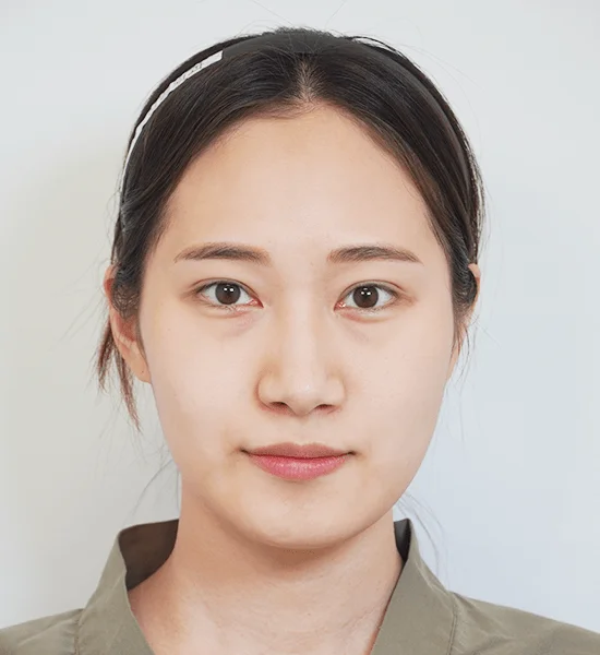 Asian woman face, 345 plastic surgery where natural results, before and after.