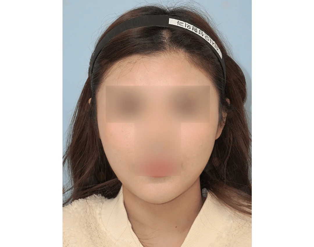Asian woman with headband for 345 plastic surgery where natural look is desired.