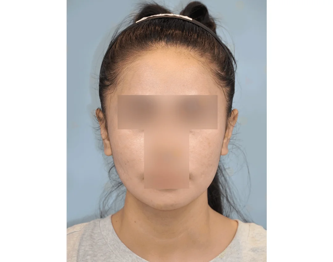 Asian woman before 345 plastic surgery for natural results.