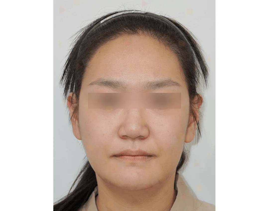 Asian woman face before 345 Plastic Surgery where natural