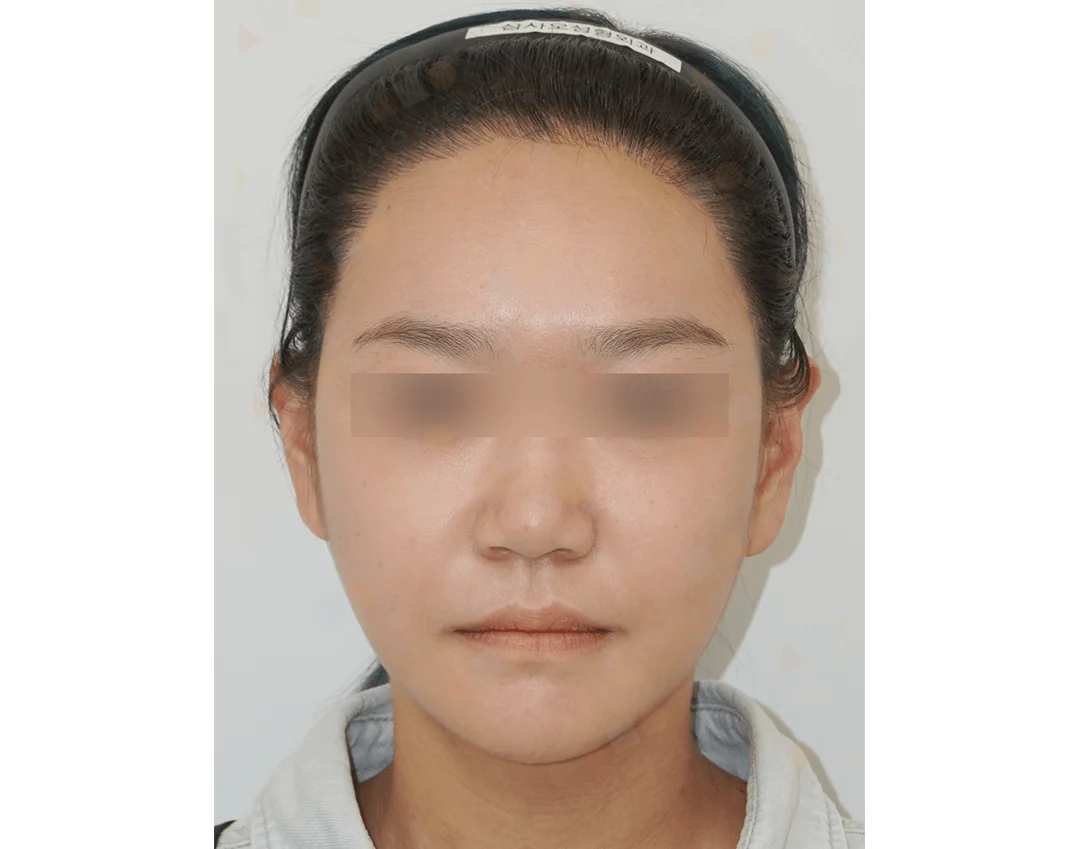 Asian woman face before 345 plastic surgery where natural face contouring.