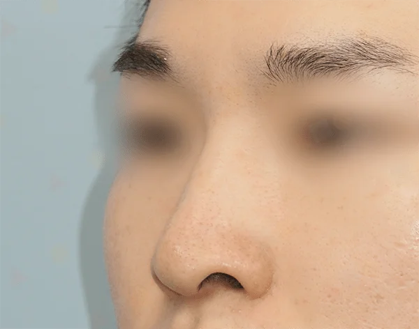 Close-up of a face showing natural 345 plastic surgery results.
