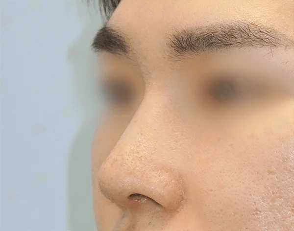 Profile view of a nose before 345 plastic surgery where natural.