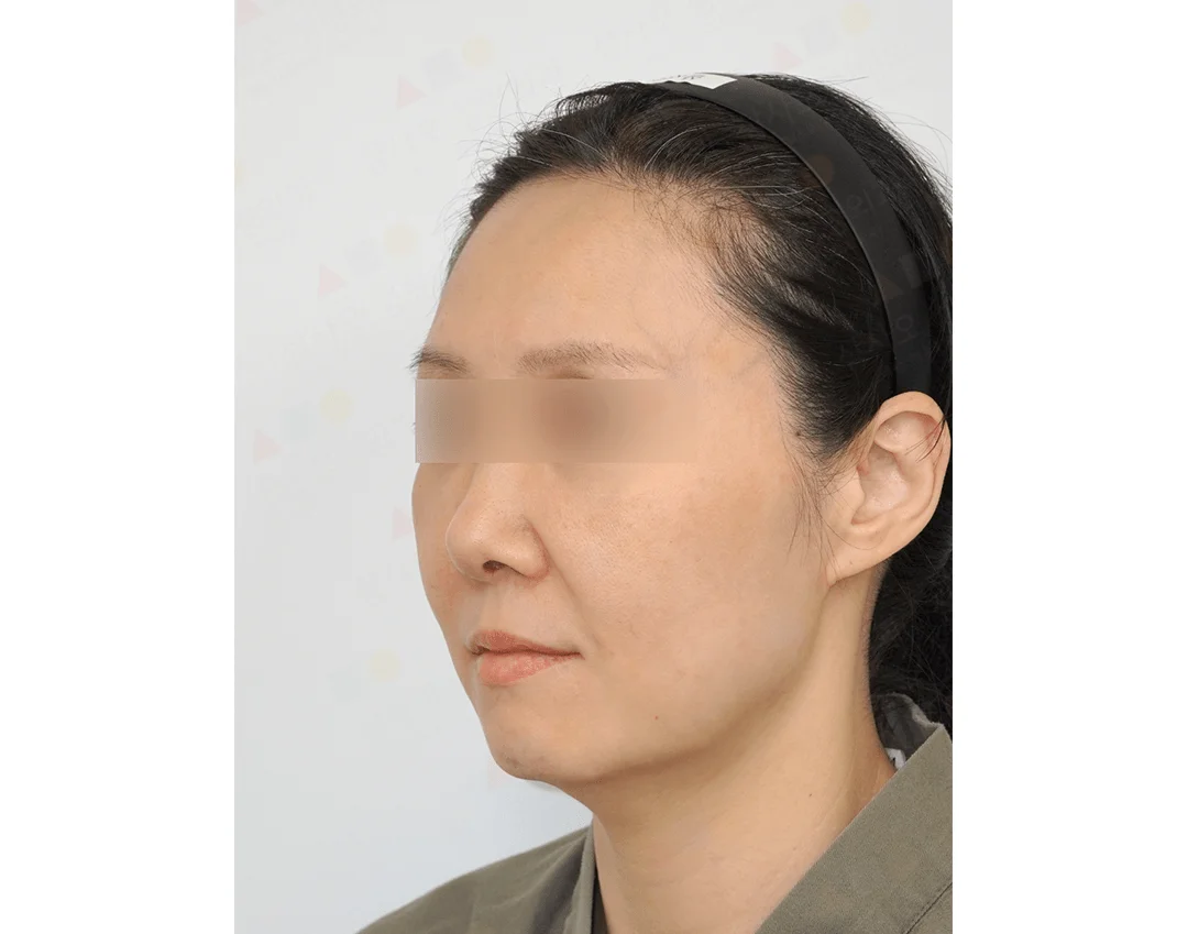 Woman's face before 345 plastic surgery for natural results. Side view.