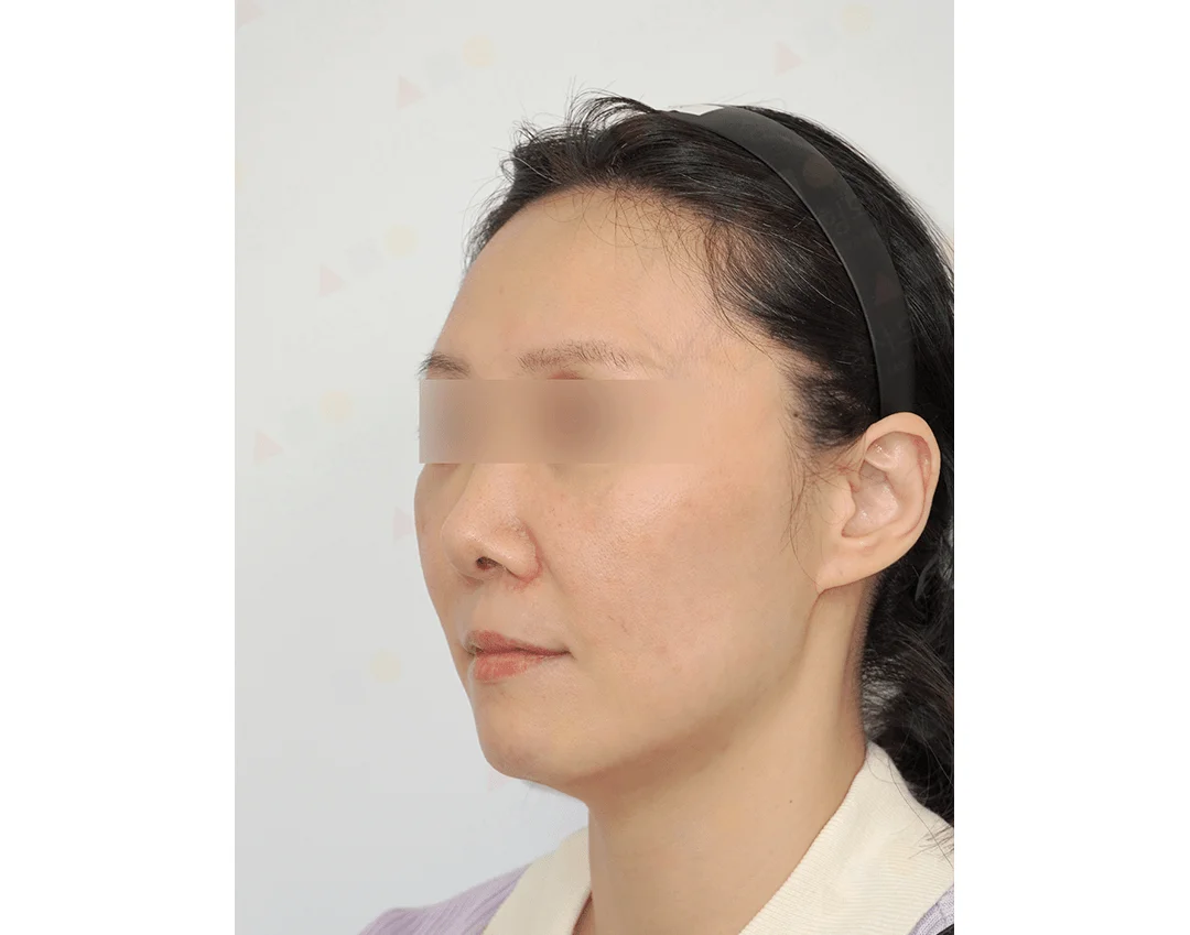 Asian woman's face profile before 345 plastic surgery where natural look is desired.