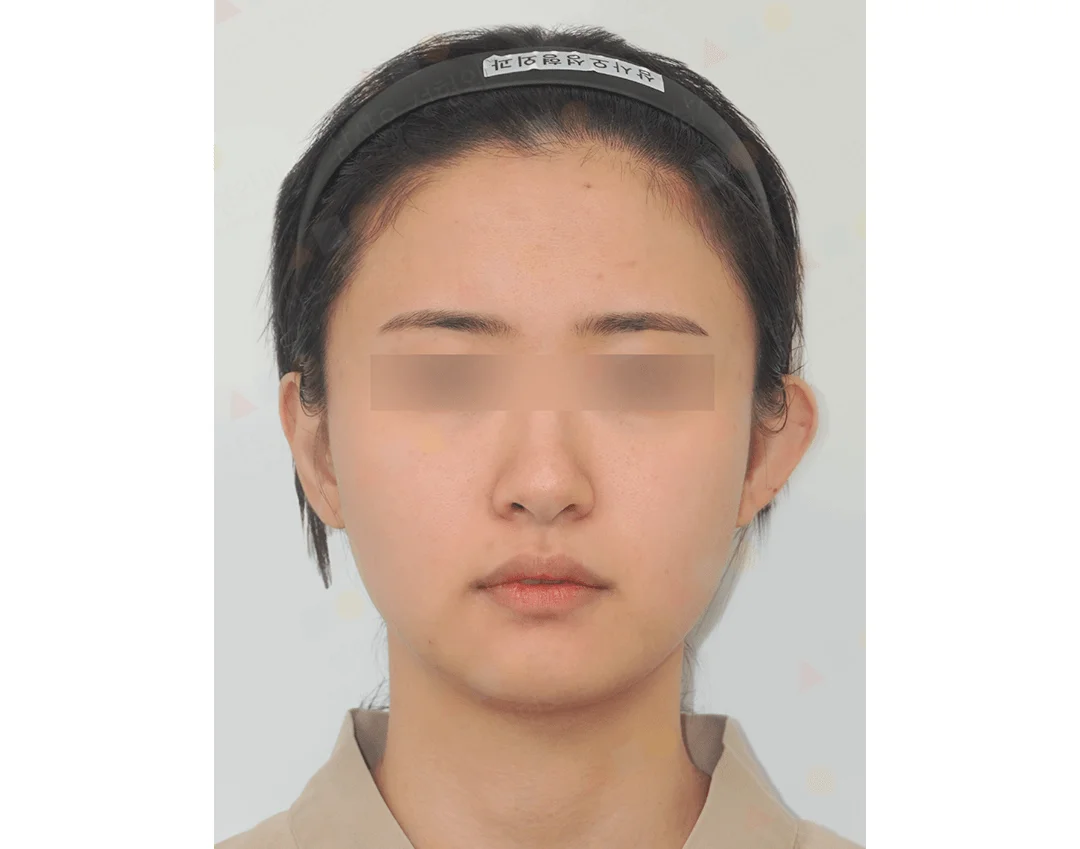 Asian woman before 345 plastic surgery where natural face is shown.