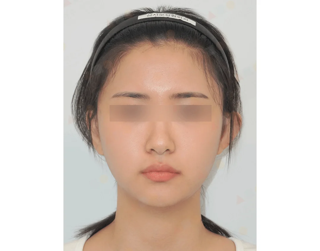 Asian woman face before 345 plastic surgery where natural face contouring.
