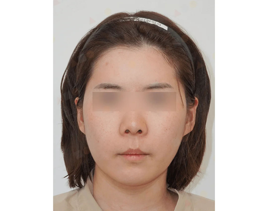 Asian woman before 345 plastic surgery procedure where natural results are desired.